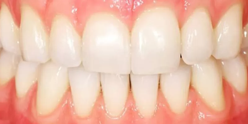 invisalign-dupa-1