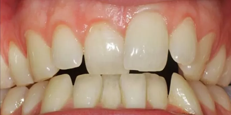 invisalign-inainte-1