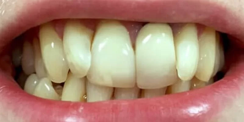 invisalign-inainte-3