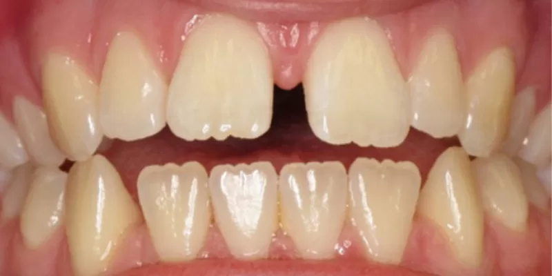 reabilitare-aparat-dentar-invisalign-inainte-4