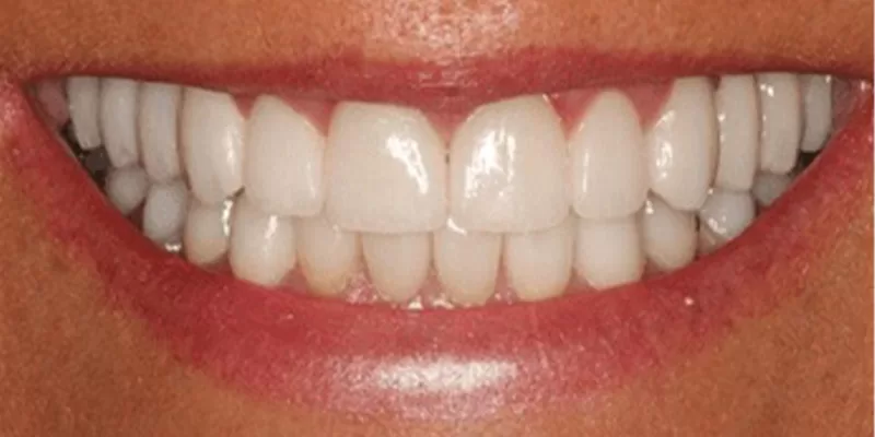 reabilitare-implant-coroane-zirconiu-dupa-3