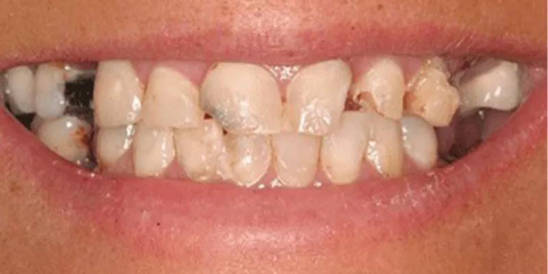 reabilitare-implant-coroane-zirconiu-inainte-3